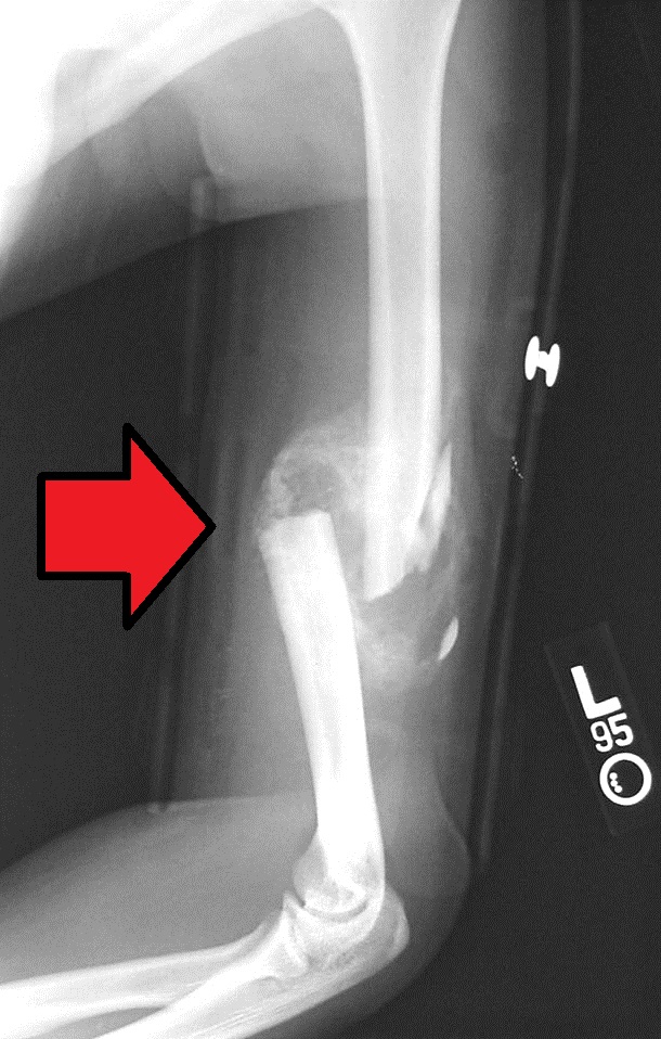 X-ray showing a comminuted mid-shaft humeral fracture with callus formation
