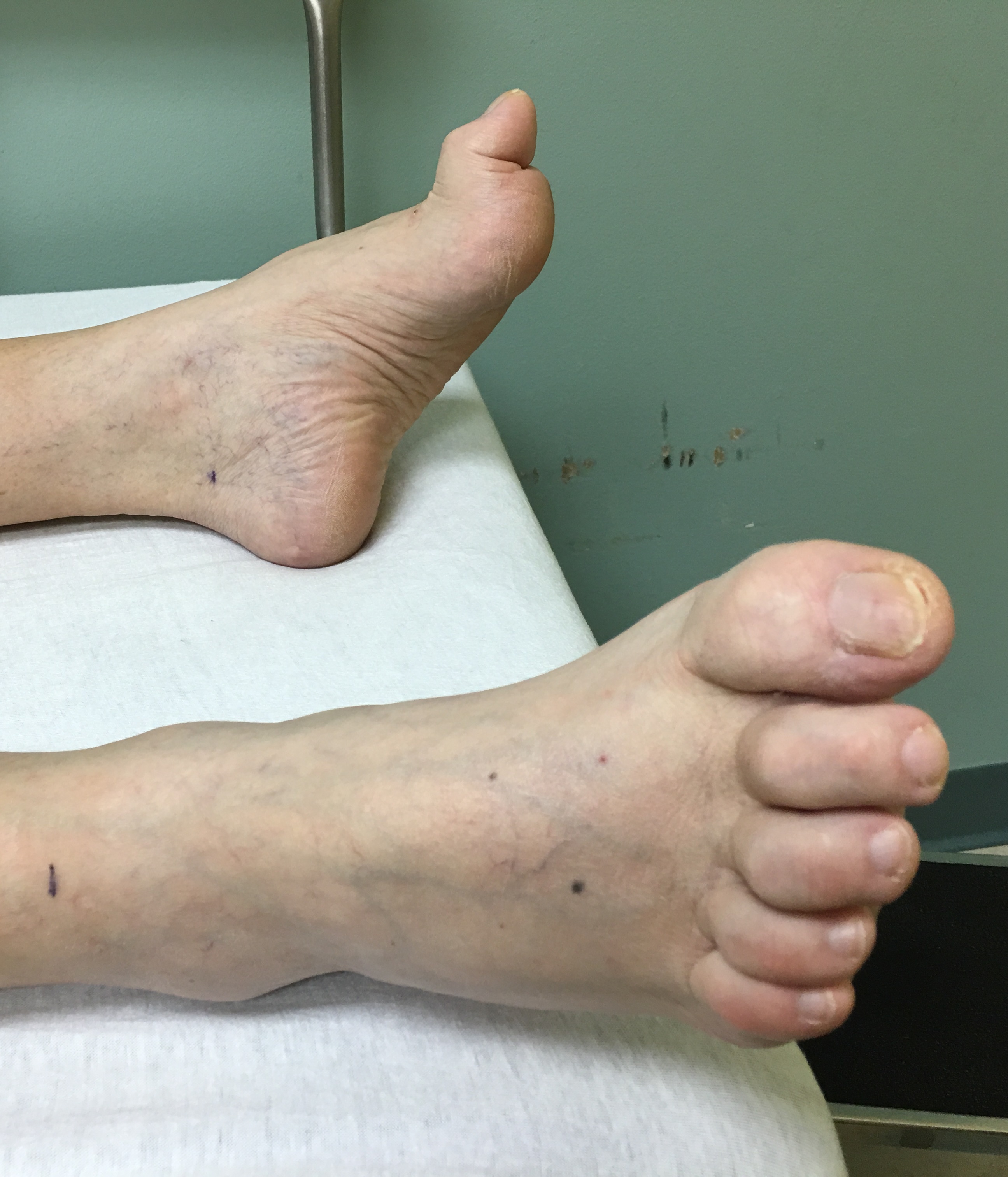 Photograph of a foot showing hammer-toe deformity of the lesser toes