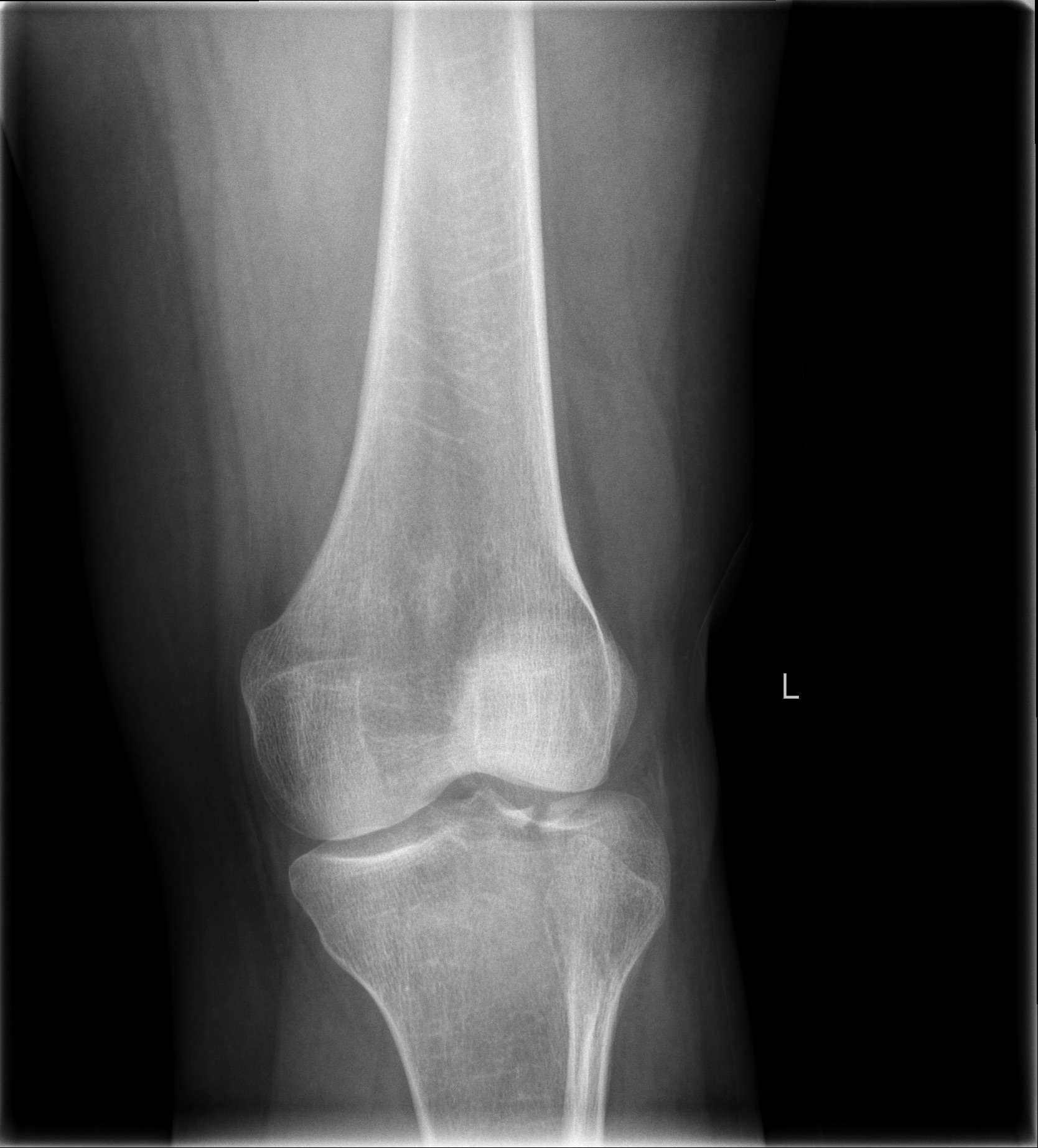 Knee X-ray showing a depressed lateral tibial-plateau fracture