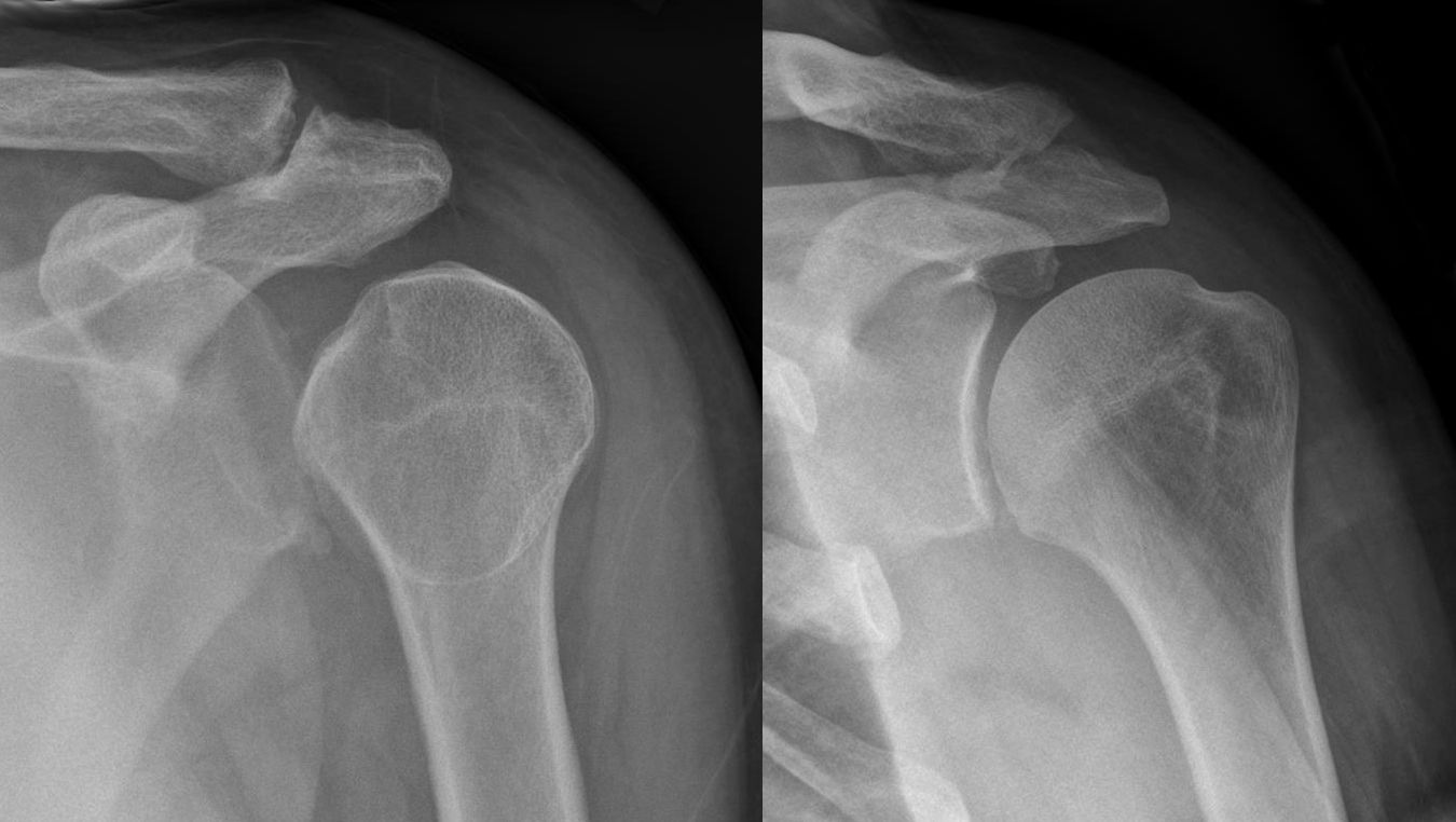 Shoulder X-ray showing the 'lightbulb sign' of posterior shoulder dislocation