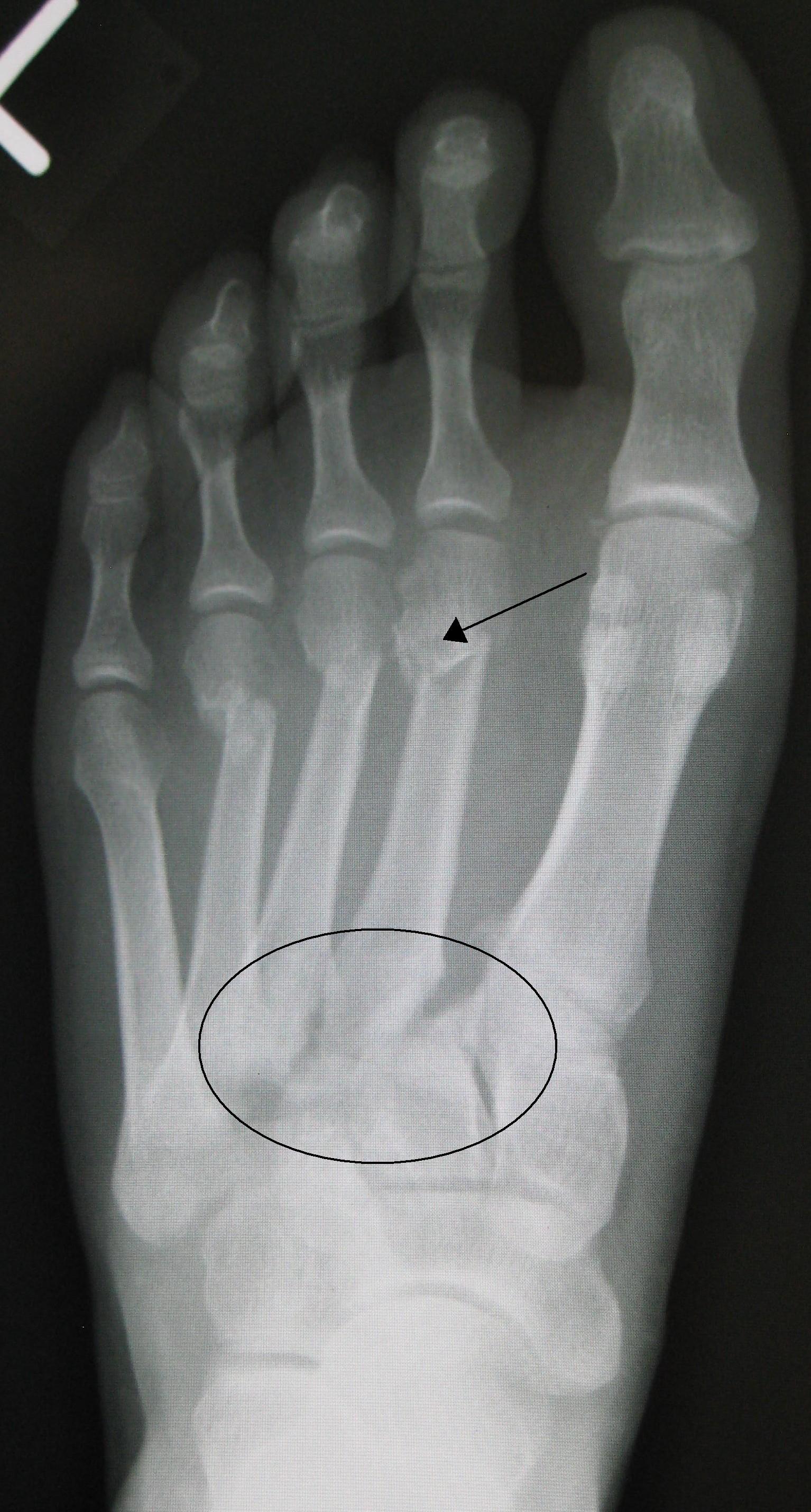 Anteroposterior foot X-ray of a Lisfranc tarsometatarsal fracture–dislocation