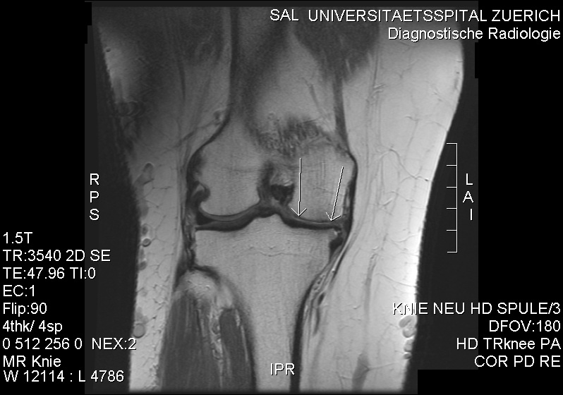 Knee MRI showing a full-thickness cartilage defect at the medial femorotibial joint