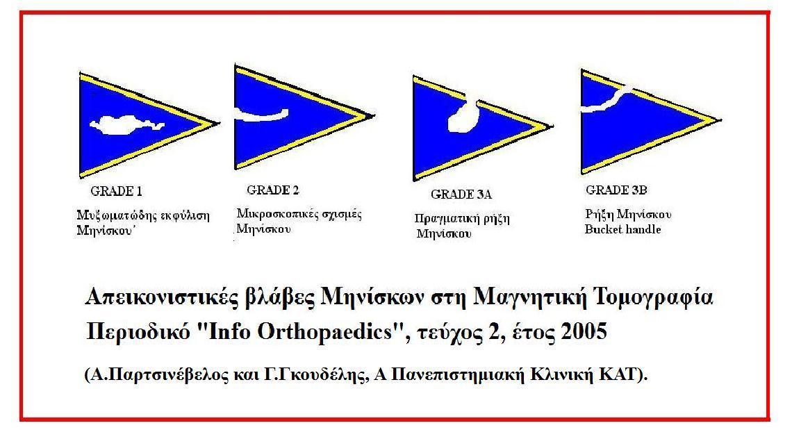 Knee MRI showing a posterior-horn meniscus tear