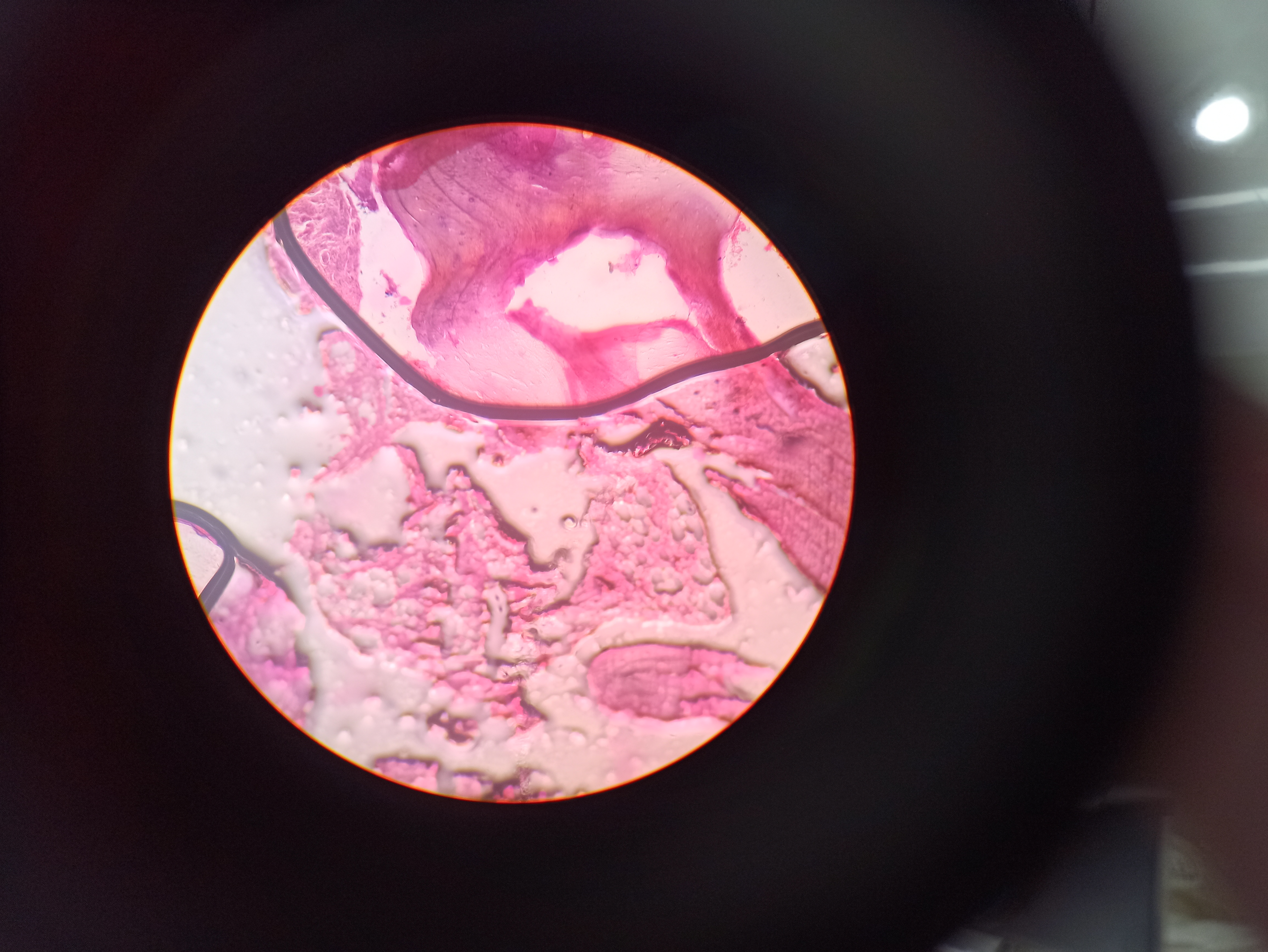 Radiograph of a long bone with findings of osteomyelitis
