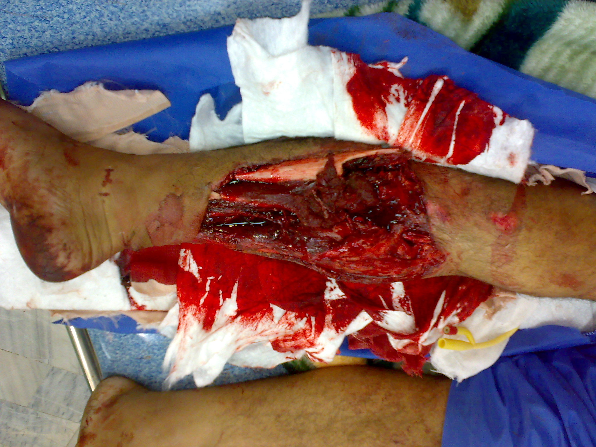 X-ray showing a displaced tibial shaft fracture