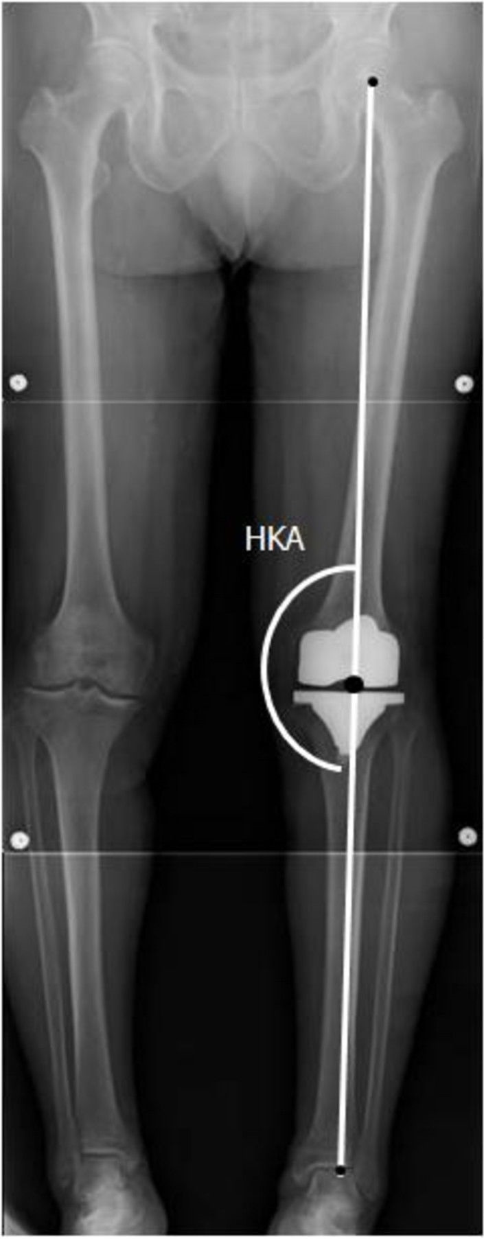 Post-operative knee replacement X-ray showing femoral and tibial prosthetic components