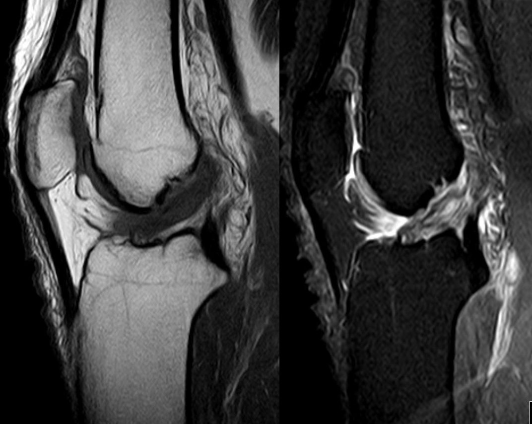 Sagittal knee MRI showing a complete tear of the anterior cruciate ligament