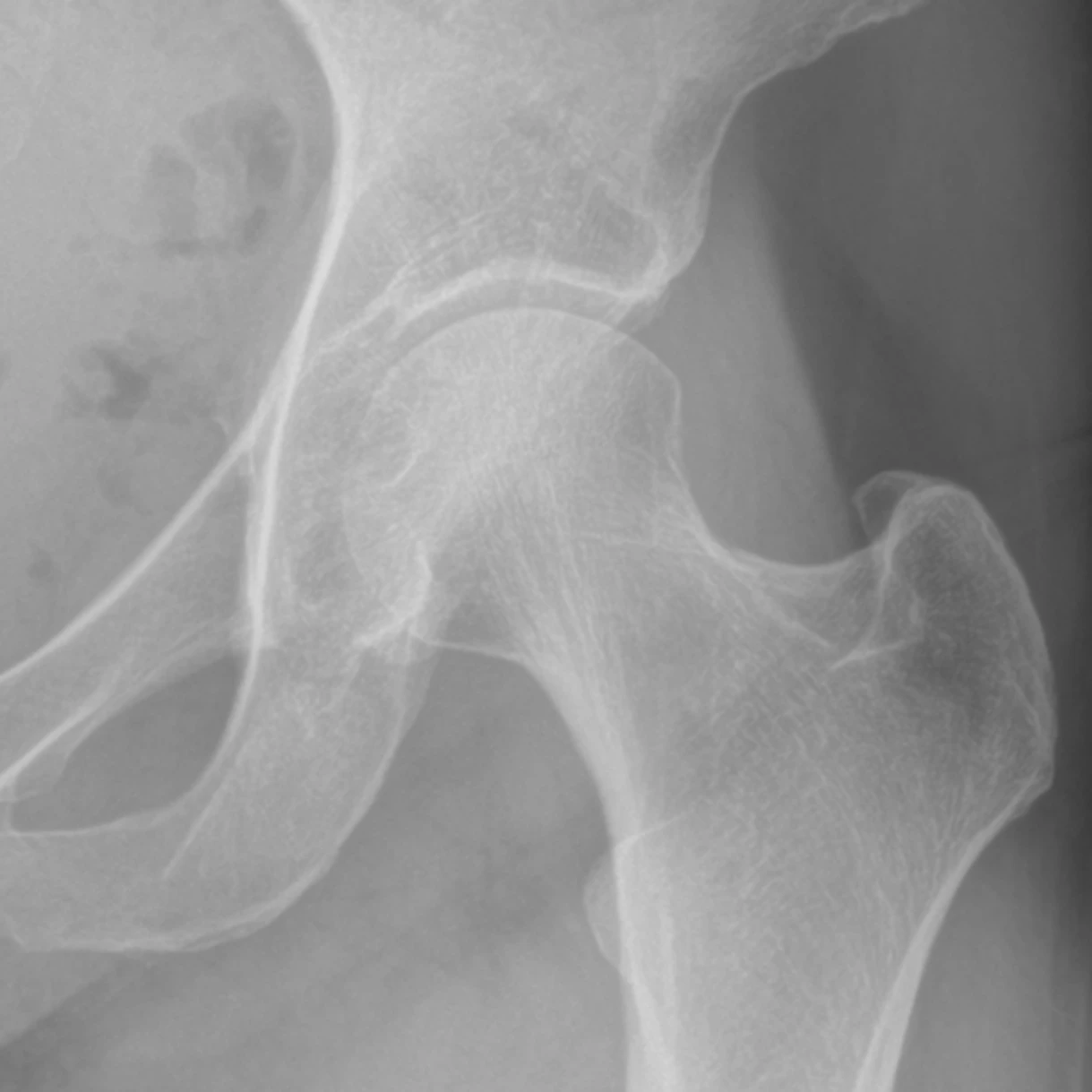 X-ray of a healthy hip for comparison, showing a smooth, evenly bright ball sitting in the socket.