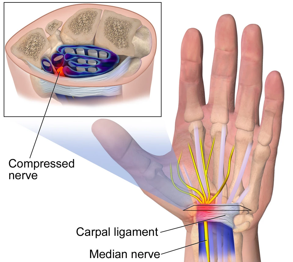 Illustration of the carpal tunnel at the wrist: the median nerve passing under the transverse carpal ligament alongside the finger tendons, with an inset cross-section showing the nerve compressed inside the tunnel.