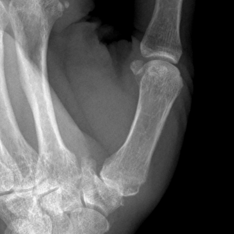 Preoperative oblique X-ray zoomed on the thumb CMC joint, osteophytes and loss of joint space at the base of the thumb.