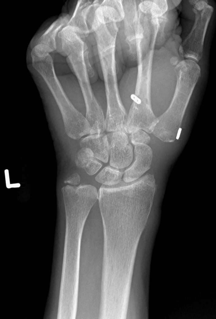 Postoperative PA X-ray of a thumb CMC arthroplasty