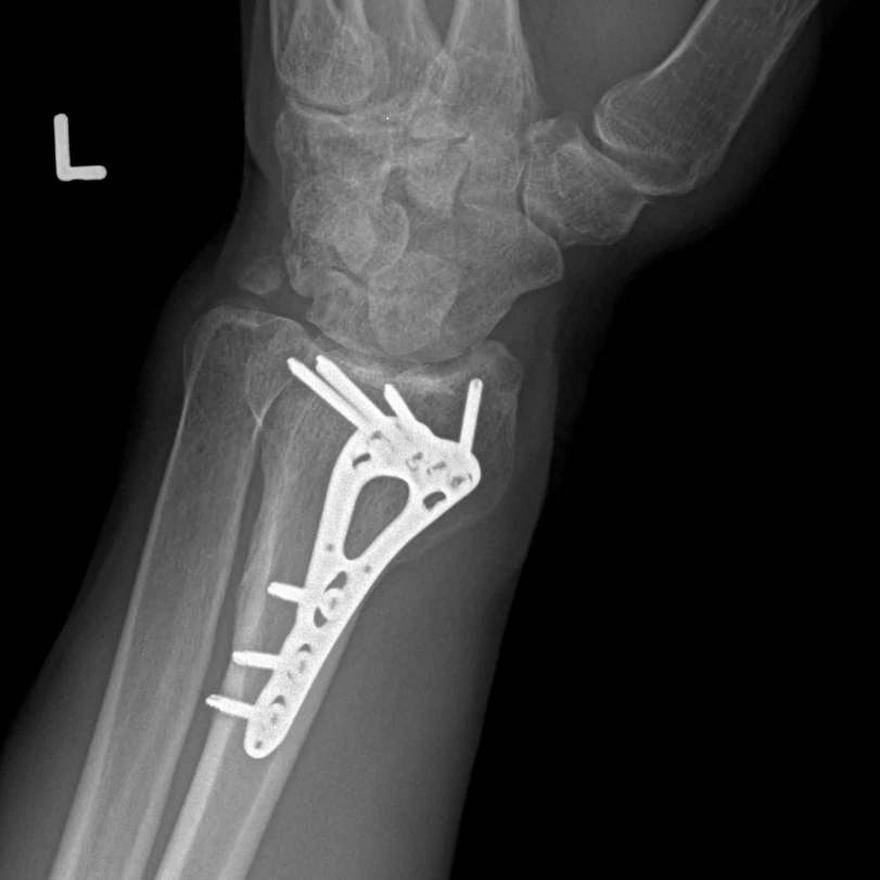 Postoperative X-ray of the same distal radius volar plate and screws in a second projection.