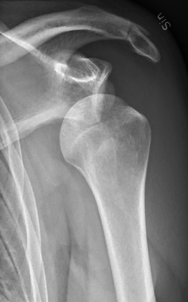 AP shoulder X-ray showing an anterior shoulder dislocation with the humeral head displaced below and medial to the glenoid.