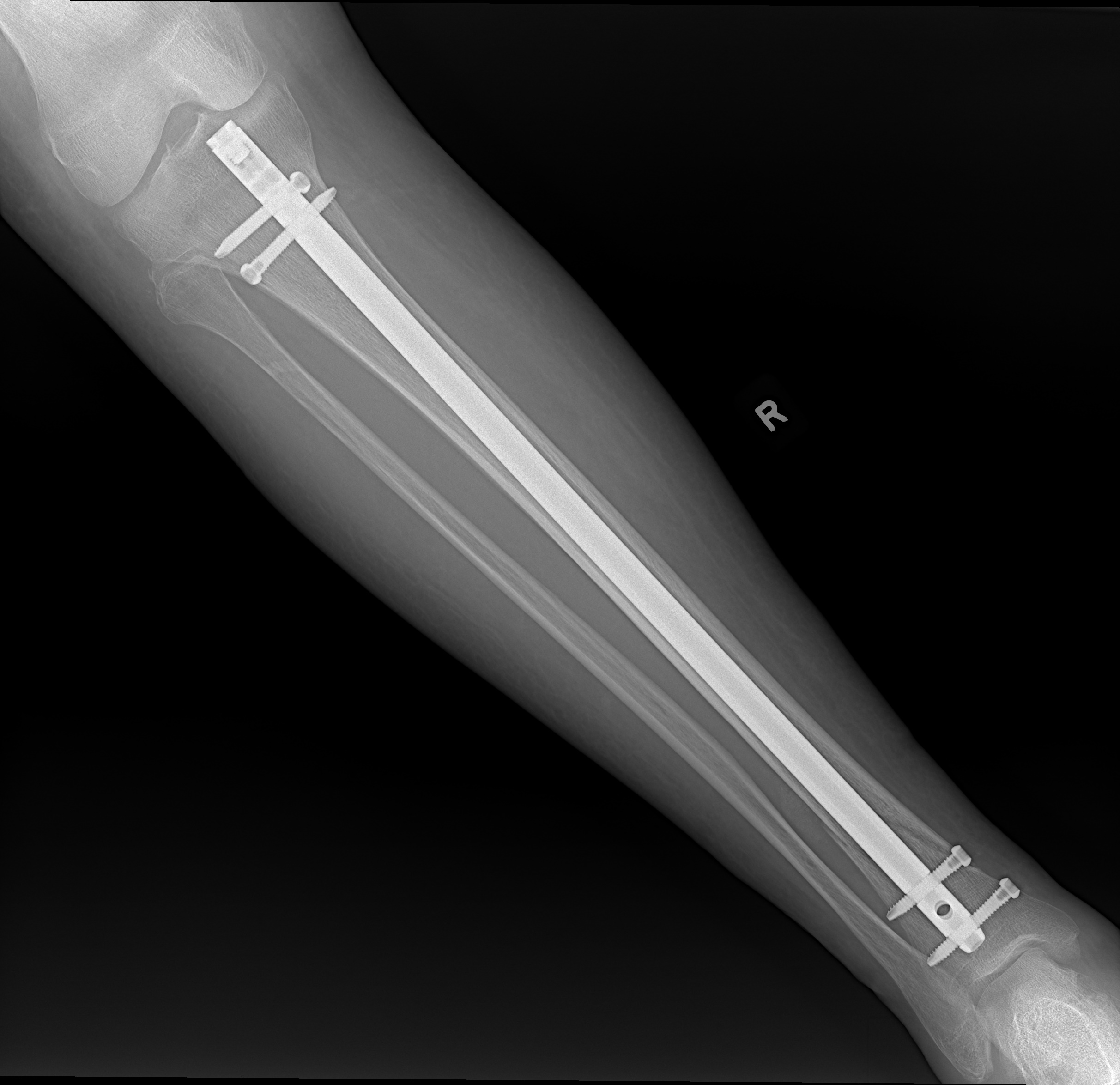 Postoperative X-ray of a tibial shaft fracture treated with an intramedullary nail with interlocking screws above and below the fracture.