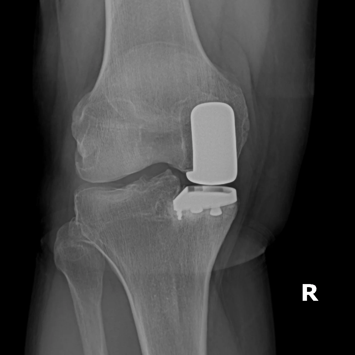 Front-view X-ray of a knee after partial knee replacement, showing a metal cap on the end of the femur and a small metal tray on the tibia on one side of the joint.