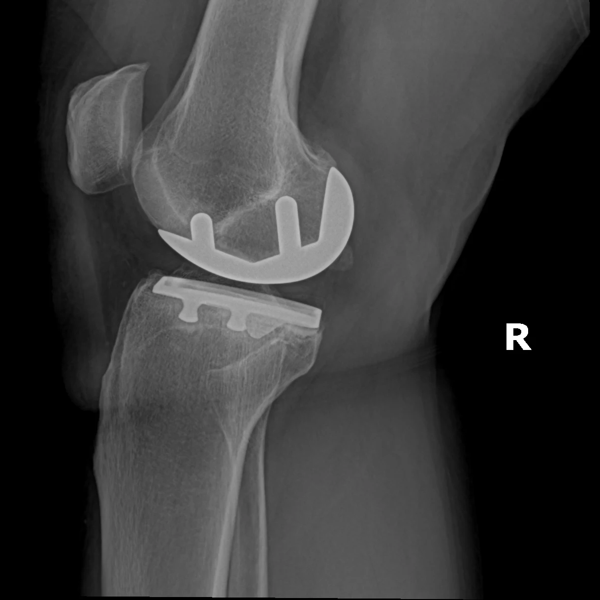 Side-view X-ray of a partial knee replacement, showing the curved metal cap following the end of the femur and the flat tray on the tibia.